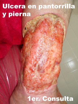 triple Represalias espada Ulceras venosas en las piernas - Tratamiento de ulceras varicosas