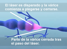 varicoza foluxie laser pre laser
