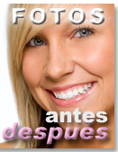 Antes - Después